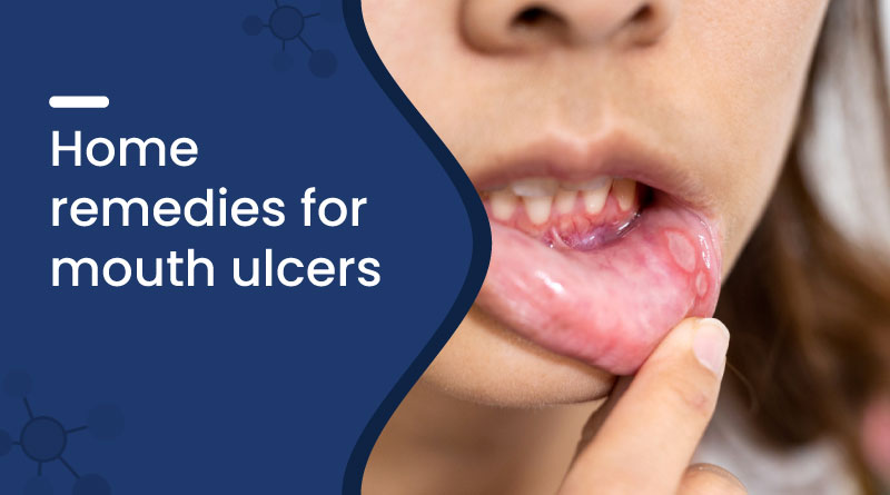 Home Remedies for Mouth Ulcers &ndash; Fast Relief with Natural Care