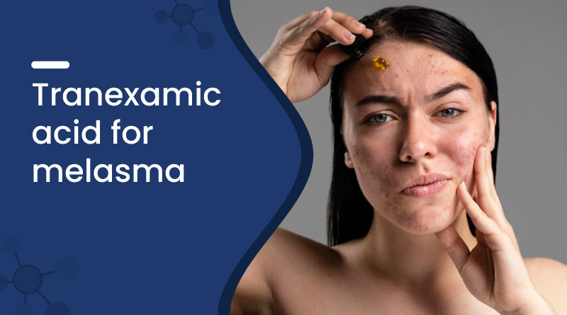 Tranexamic Acid for Melasma | Best Treatment for Pigmentation