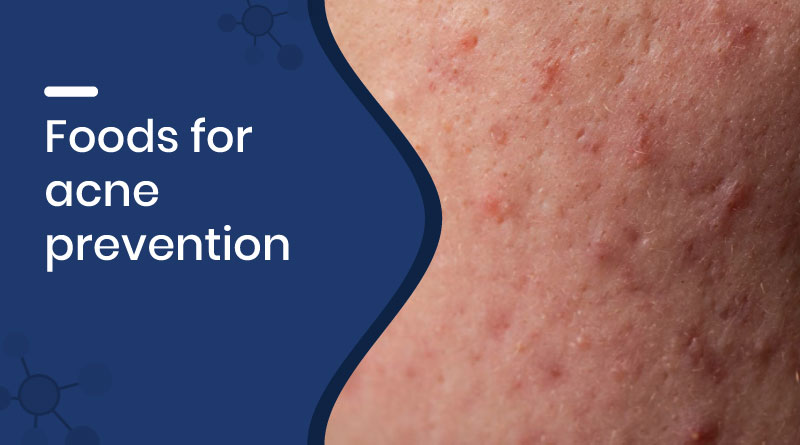 Best Foods for Acne Prevention