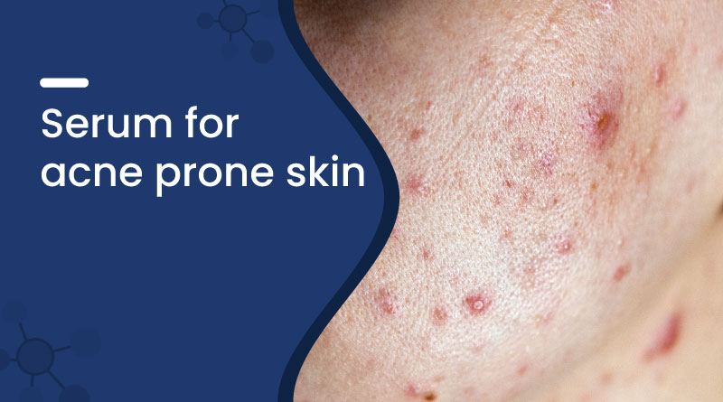 Best Serum for Acne Prone Skin &ndash; Control Breakouts Naturally