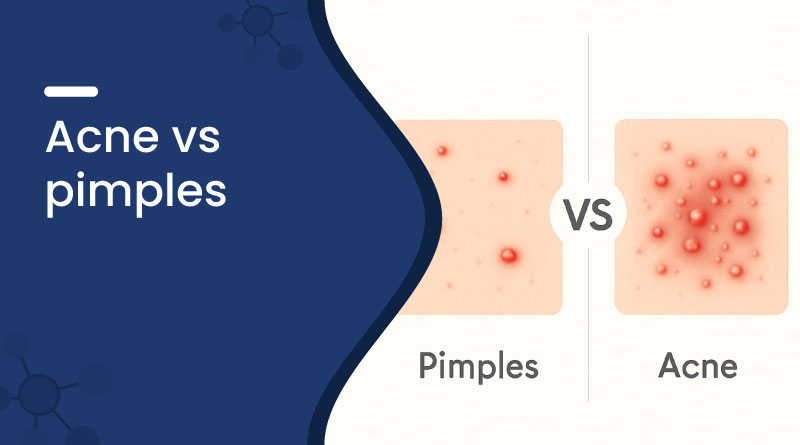 Acne vs Pimples 