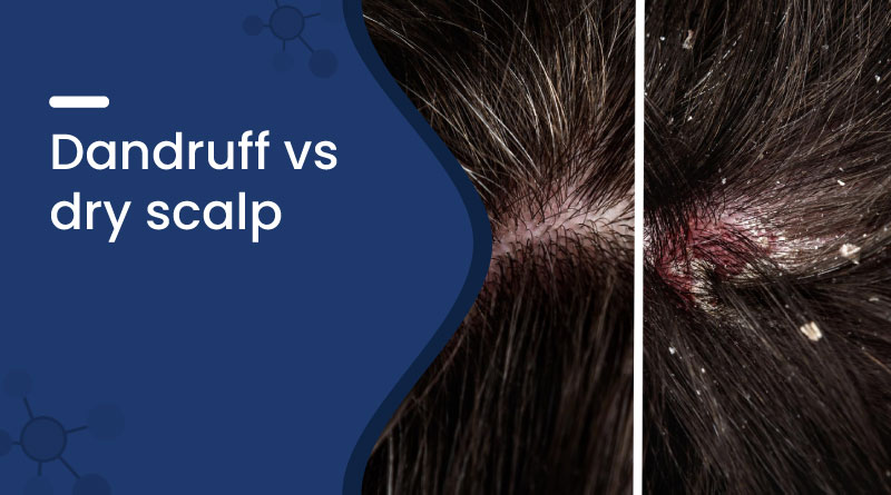 Dandruff vs Dry Scalp | Key Differences & Treatment Tips