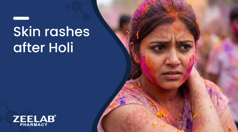 https://www.zeelabhealth.com/public/uploads/blogs/skin-rashes-after-holi-treatment-causes-medicines.jpg